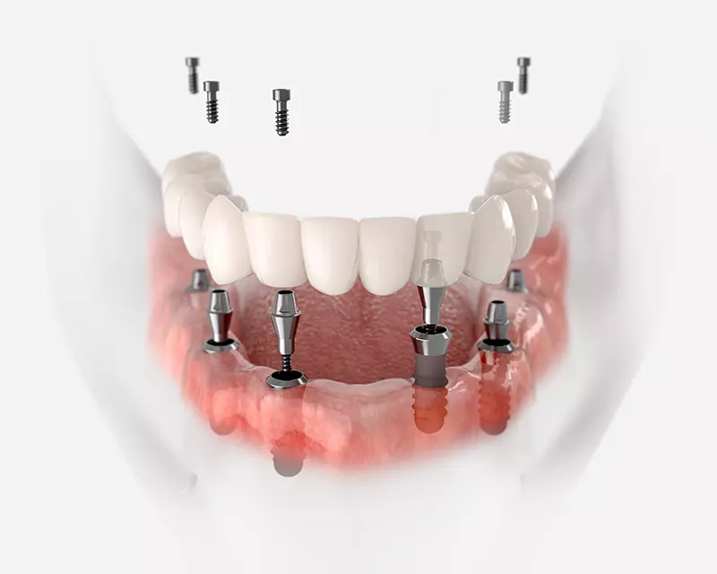 Implant Supported Dentures